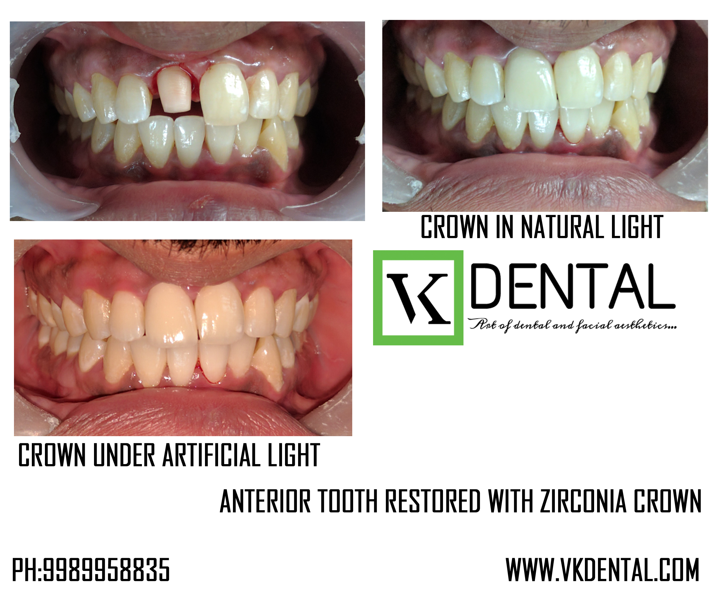 SMILE CORRECTION/DESIGNING